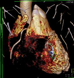 Plaque Left Anterior Descending Coronary Artery (LAD) Without Stenosis - CTisus CT Scan