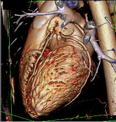 Plaque Left Anterior Descending Coronary Artery (LAD) Without Stenosis - CTisus CT Scan