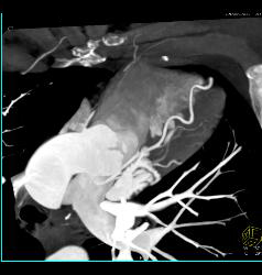 Stent in Left Anterior Descending Coronary Artery (LAD) and Plaque Proximal to Stent - CTisus CT Scan