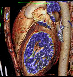 Stent in Left Anterior Descending Coronary Artery (LAD) and Plaque Proximal to Stent - CTisus CT Scan