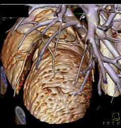 Stent in Left Anterior Descending Coronary Artery (LAD) and Plaque Proximal to Stent - CTisus CT Scan