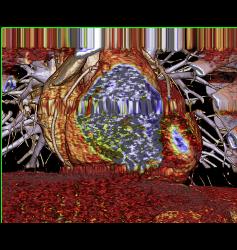 Fat in Wall of Right Ventricle - CTisus CT Scan