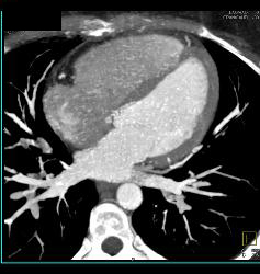 Fat in Wall of Right Ventricle - CTisus CT Scan