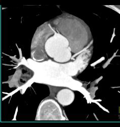 Extensive Plaque Left Anterior Descending Coronary Artery (LAD) - CTisus CT Scan