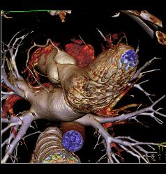 Extensive Plaque Left Anterior Descending Coronary Artery (LAD) - CTisus CT Scan