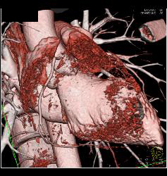 Extensive Plaque Left Anterior Descending Coronary Artery (LAD) - CTisus CT Scan