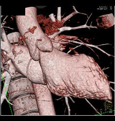 Fat in Wall of Right Ventricle - CTisus CT Scan