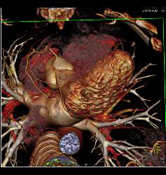 Left Anterior Descending Coronary Artery (LAD) Plaque Without Stenosis - CTisus CT Scan