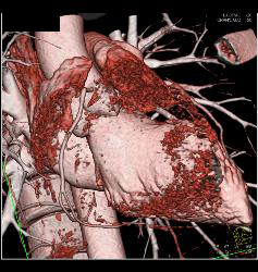 Fat in Wall of Right Ventricle - CTisus CT Scan