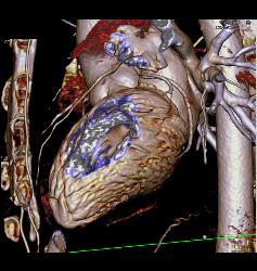 Fat in Wall of Right Ventricle - CTisus CT Scan