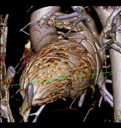 Left Anterior Descending Coronary Artery (LAD) Disease - CTisus CT Scan