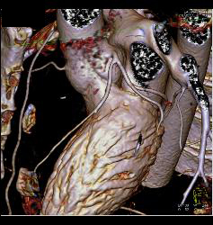 Multiple Plaques in RCA With Less Than 50% Stenosis in Select Zones and Greater Than 70% in Distal RCA - CTisus CT Scan