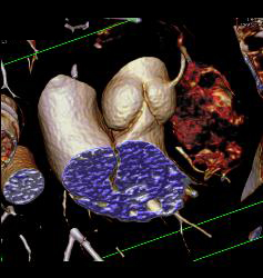 Multiple Plaques in RCA With Less Than 50% Stenosis in Select Zones and Greater Than 70% in Distal RCA - CTisus CT Scan