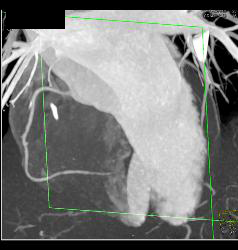 Multiple Plaques in RCA With Less Than 50% Stenosis in Select Zones and Greater Than 70% in Distal RCA - CTisus CT Scan