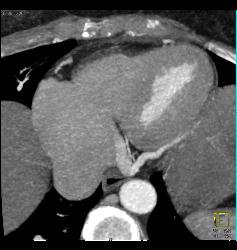 Multiple Plaques in RCA With Less Than 50% Stenosis in Select Zones and Greater Than 70% in Distal RCA - CTisus CT Scan