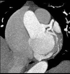 Multiple Plaques in RCA With Less Than 50% Stenosis in Select Zones and Greater Than 70% in Distal RCA - CTisus CT Scan