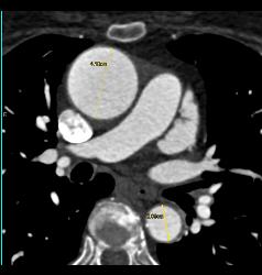 Multiple Plaques in RCA With Less Than 50% Stenosis in Select Zones and Greater Than 70% in Distal RCA - CTisus CT Scan