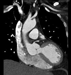 Multiple Plaques in RCA With Less Than 50% Stenosis in Select Zones and Greater Than 70% in Distal RCA - CTisus CT Scan