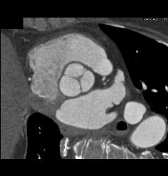 Multiple Plaques in RCA With Less Than 50% Stenosis in Select Zones and Greater Than 70% in Distal RCA - CTisus CT Scan