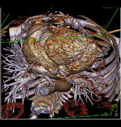 Multiple Plaques in RCA With Less Than 50% Stenosis in Select Zones and Greater Than 70% in Distal RCA - CTisus CT Scan