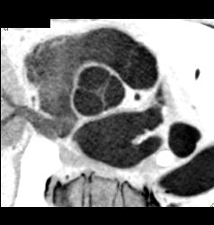 Multiple Plaques in RCA With Less Than 50% Stenosis in Select Zones and Greater Than 70% in Distal RCA - CTisus CT Scan