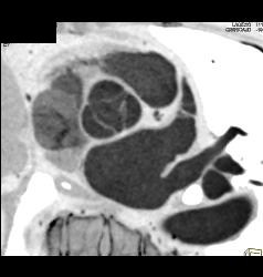 Multiple Plaques in RCA With Less Than 50% Stenosis in Select Zones and Greater Than 70% in Distal RCA - CTisus CT Scan