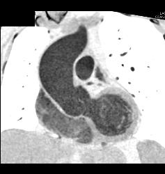 Left Internal Mammary Artery (LIMA) Graft and Venous Graft - CTisus CT Scan