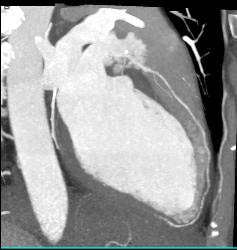 Left Internal Mammary Artery (LIMA) Graft and Venous Graft - CTisus CT Scan