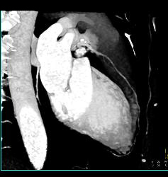 Fat in Wall of Right Ventricle - CTisus CT Scan