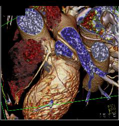 Venous Bypass Grafts and Left Internal Mammary Artery (LIMA) Graft - CTisus CT Scan