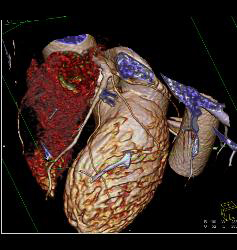 Venous Bypass Grafts and Left Internal Mammary Artery (LIMA) Graft - CTisus CT Scan