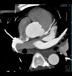 Venous Bypass Grafts and Left Internal Mammary Artery (LIMA) Graft - CTisus CT Scan