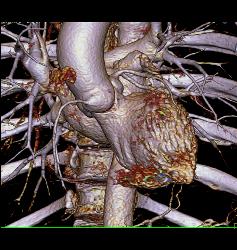 Venous Bypass Grafts and Left Internal Mammary Artery (LIMA) Graft - CTisus CT Scan