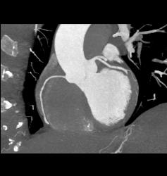 Venous Bypass Grafts and Left Internal Mammary Artery (LIMA) Graft - CTisus CT Scan