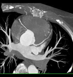 Normal Left Atrial Appendage. Note Incidental Hepatocellular Carcinoma (Hepatoma) in Cardiac CTA Patient - CTisus CT Scan