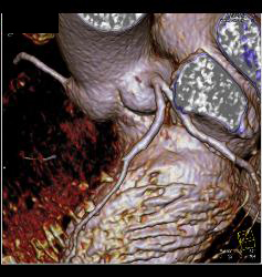 Normal Left Atrial Appendage. Note Incidental Hepatocellular Carcinoma (Hepatoma) in Cardiac CTA Patient - CTisus CT Scan