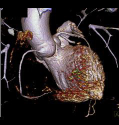 Volume Rendering and MIP of Vessels - CTisus CT Scan