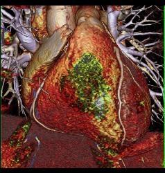 Volume Rendering and MIP of Vessels - CTisus CT Scan