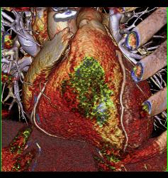 Volume Rendering and MIP of Vessels - CTisus CT Scan