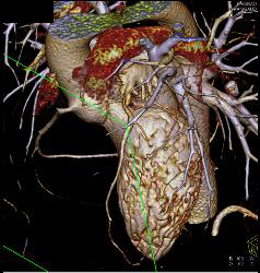 Extensive Left Anterior Descending Coronary Artery (LAD) Disease - CTisus CT Scan