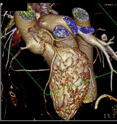 Extensive Left Anterior Descending Coronary Artery (LAD) Disease - CTisus CT Scan