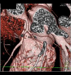 Extensive Left Anterior Descending Coronary Artery (LAD) Disease - CTisus CT Scan