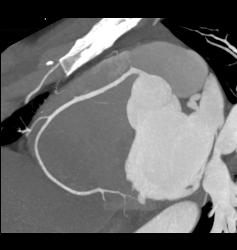 Extensive Left Anterior Descending Coronary Artery (LAD) Disease - CTisus CT Scan