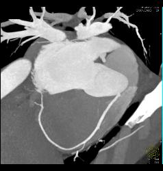 Normal Left Atrial Appendage - CTisus CT Scan