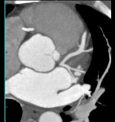 Normal Left Atrial Appendage - CTisus CT Scan