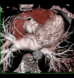 Normal Left Atrial Appendage - CTisus CT Scan