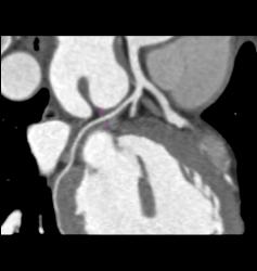 Normal Left Atrial Appendage - CTisus CT Scan