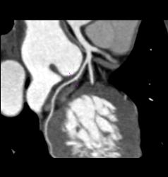 Normal Left Atrial Appendage - CTisus CT Scan