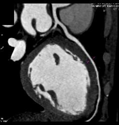 Normal Left Anterior Descending Coronary Artery (LAD) - CTisus CT Scan