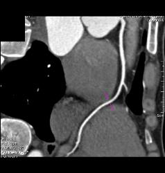 Normal Left Anterior Descending Coronary Artery (LAD) - CTisus CT Scan